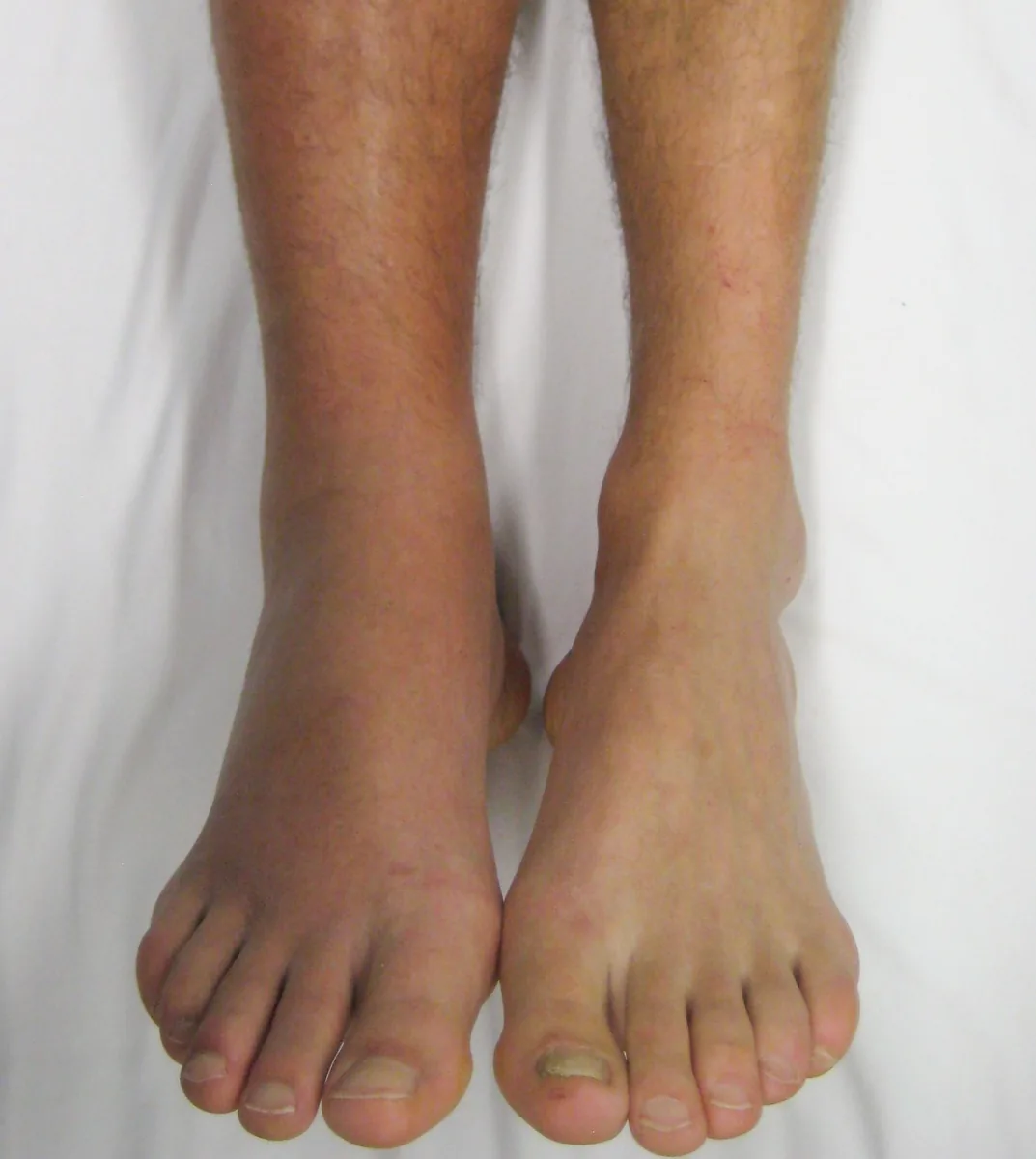 Deep vein thrombosis (blood clot in the leg) – clinical photo: Deep vein thrombosis of the right leg: swollen, reddened lower leg and foot compared with the healthy left leg