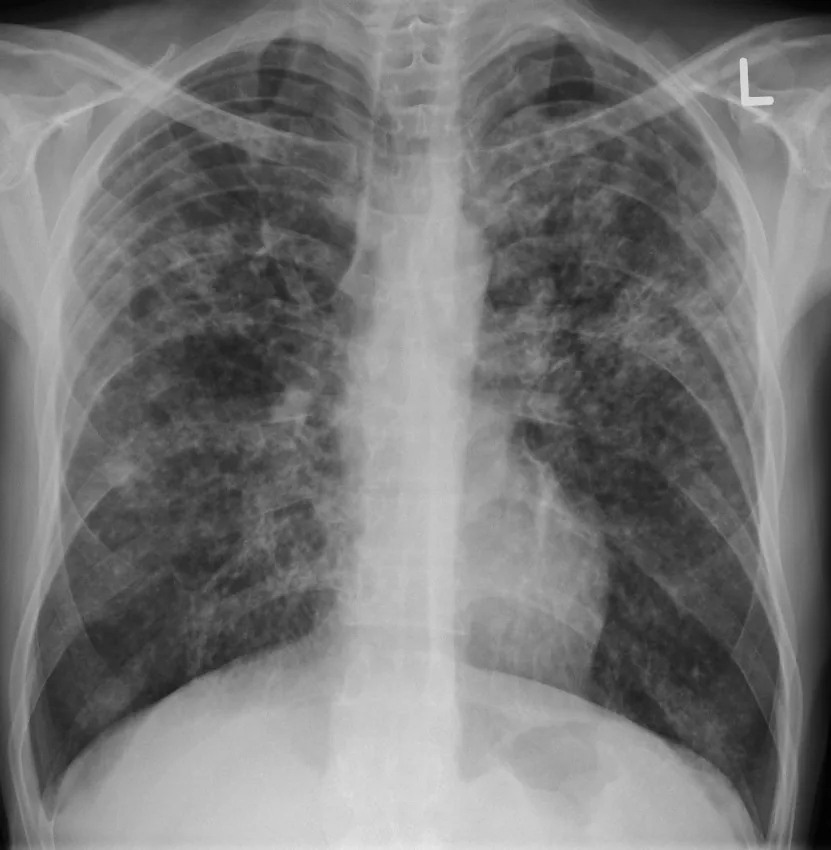 Tuberkulose – Röntgen-Thorax bei Lungentuberkulose