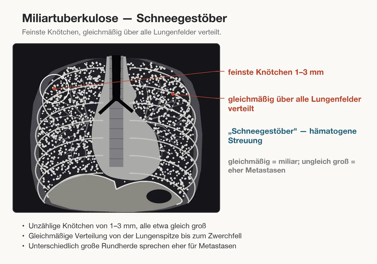 Tuberkulose – Schema (Zeichnung): Zeichnung: Miliartuberkulose – feinste, gleich große Knötchen gleichmäßig über alle Lungenfelder verteilt (Schneegestöber)