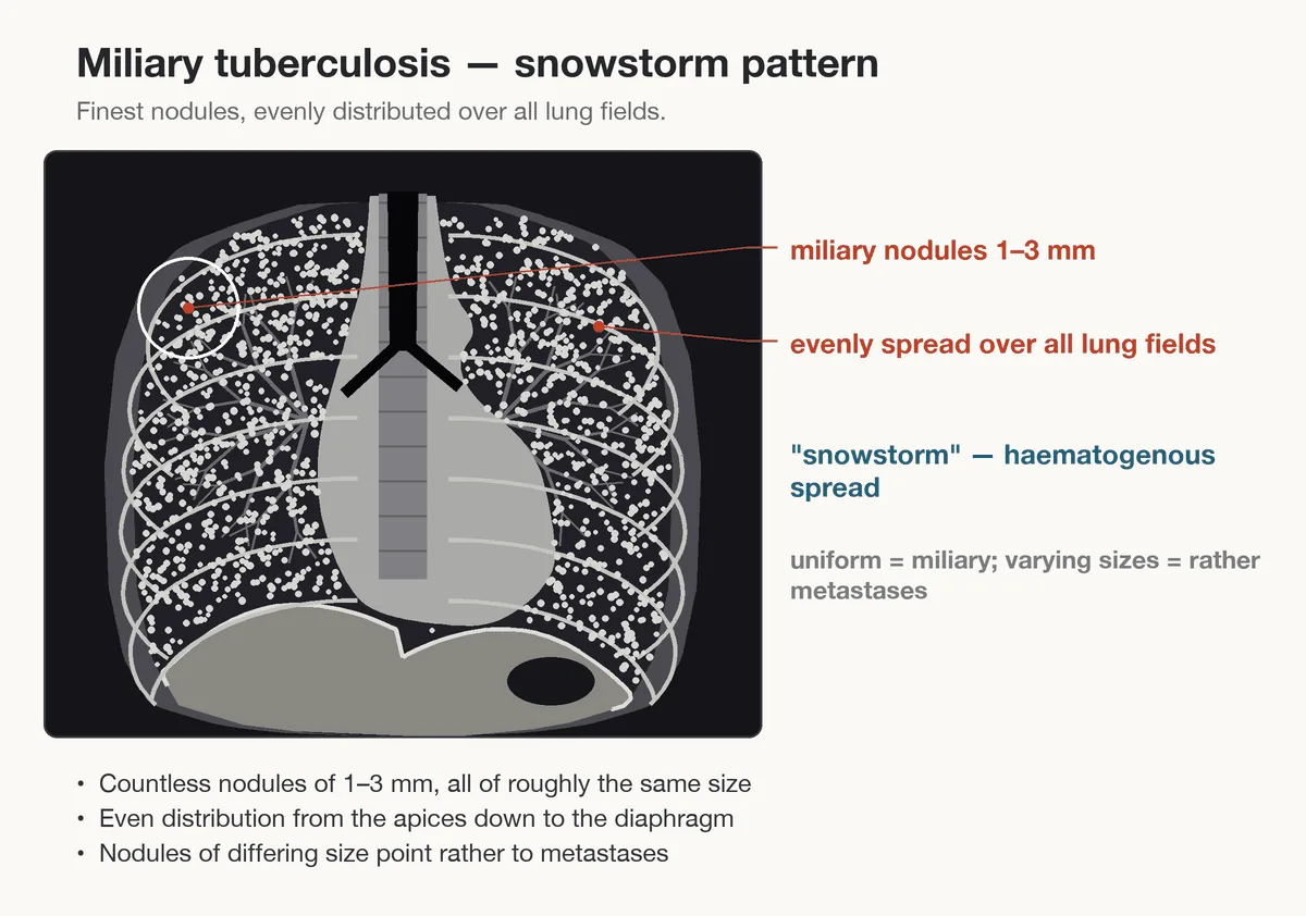 Tuberculosis – diagram: Diagram: miliary tuberculosis – tiny uniform nodules evenly distributed over all lung fields (snowstorm pattern)