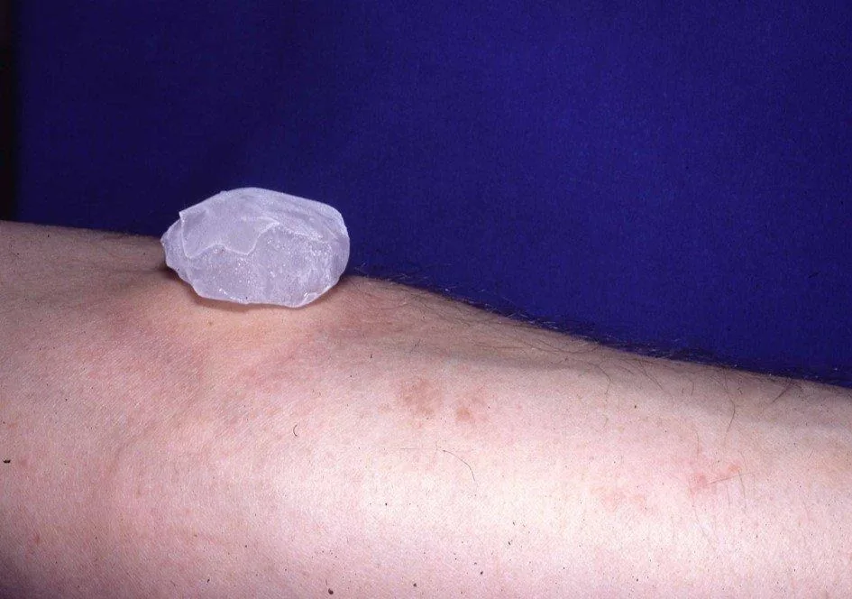 Urticaria (hives) – clinical photo: Cold urticaria: ice cube test on the forearm – a wheal forms where the ice was placed
