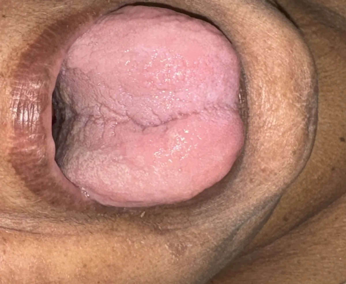 Vitamin B12 deficiency and pernicious anemia – mouth – clinical photo: Atrophic glossitis with a smooth red tongue