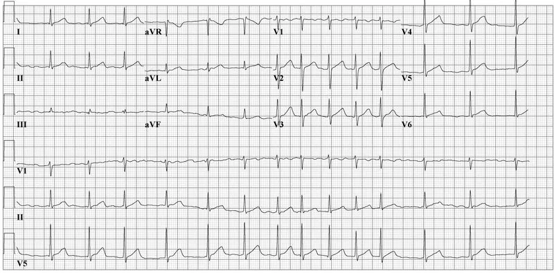 Vorhofflimmern – EKG: Absolute Arrhythmie ohne abgrenzbare P-Wellen, wechselnde RR-Abstände