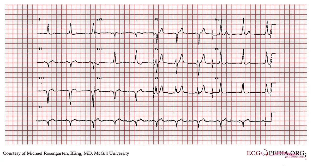 Wolff-Parkinson-White syndrome – ECG: Pre-excitation with delta wave and short PR interval