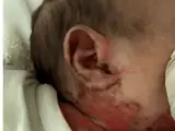 Acrodermatitis enteropathica (Zinkmangel)