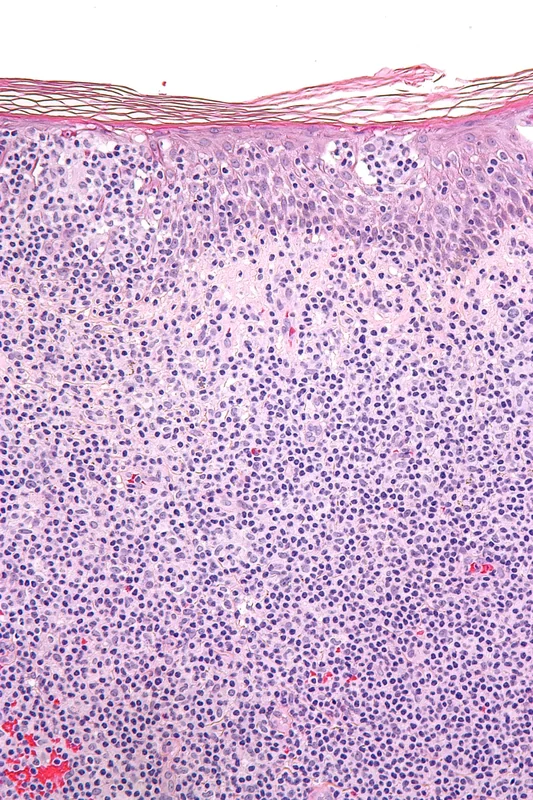Primär kutanes aggressives epidermotropes CD8-positives zytotoxisches T-Zell-Lymphom – Histologie (HE): dichtes, monomorphes Lymphozyteninfiltrat der Dermis bis an die dermoepidermale Junktion, fokaler Epidermotropismus mit einzelnen intraepidermalen Lymphozyten mit …