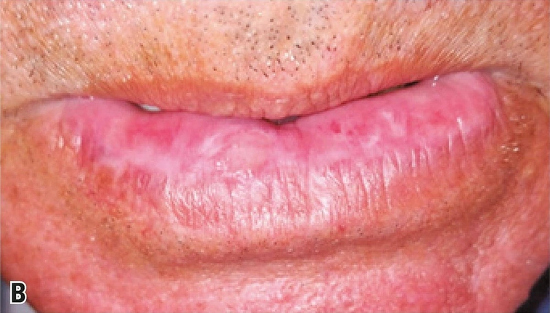 Actinic cheilitis: Whitish scaling and blurred vermilion border of the lower lip (photo: Faria, Silva, Mafra et al. (2022), Europe PMC, CC BY 4.0) (Foto: Faria, Silva, Mafra et al. (2022), Wikimedia Commons, CC BY 4.0)