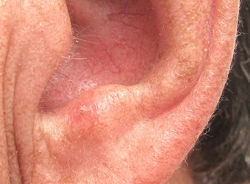 Aktinische Keratose: raue, erythematöse, schuppende Plaque auf der sonnenexponierten Ohrhelix