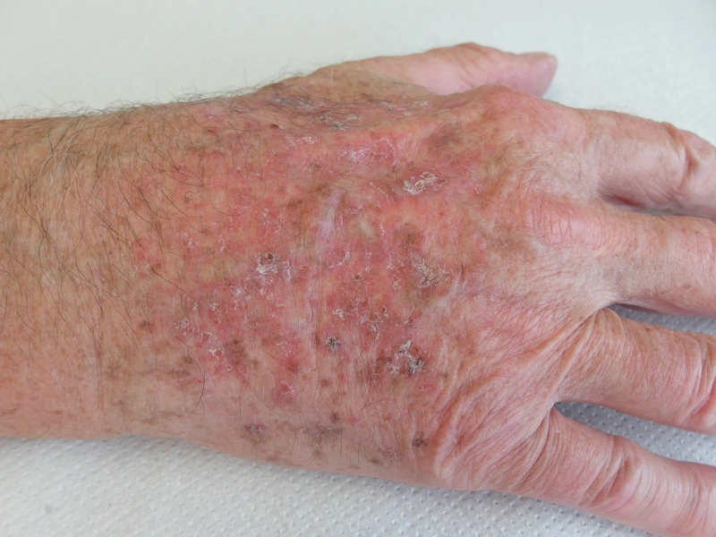 Actinic keratosis – Clinical: multiple rough, scaly reddish lesions on a sun-damaged back of the hand (field cancerization) (Photo: Dr. Thomas Brinkmeier, Wikimedia Commons, CC BY 4.0)