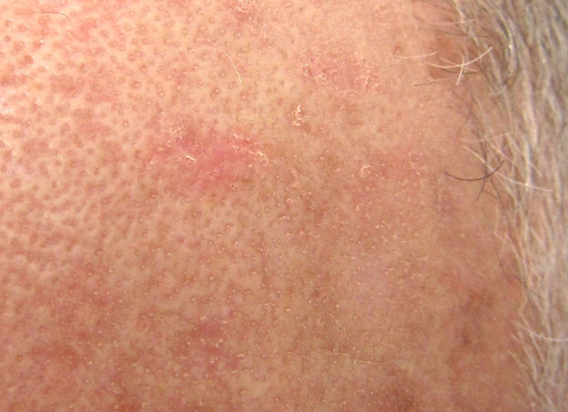 Actinic keratosis – Clinical