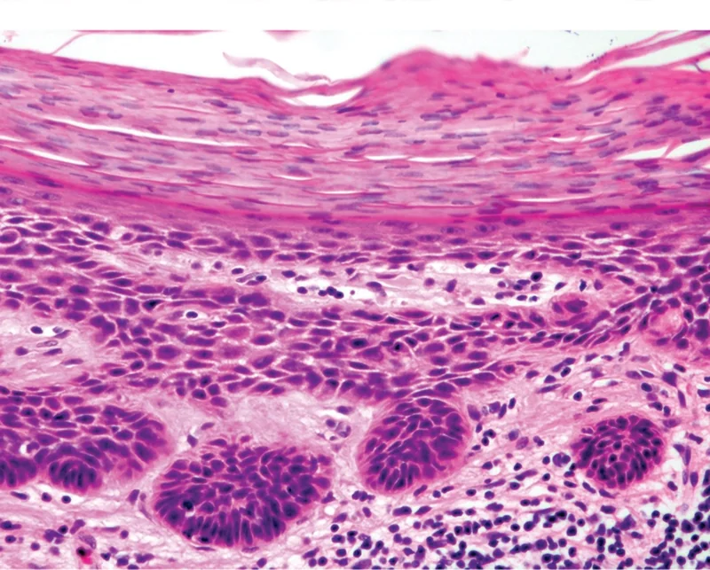 Actinic keratosis – Histology: histology (H&E): a broad band of parakeratosis over crowded atypical keratinocytes with nuclear enlargement and hyperchromasia and loss of orderly maturation, basaloid buds at the …