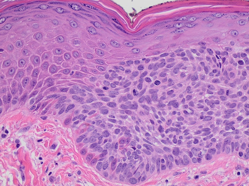 Actinic keratosis – Histology: histology (H&E): normal skin on the left, atypical basal keratinocytes not involving the full epidermal thickness on the right