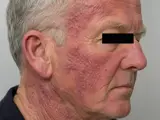 Aktinisches Retikuloid