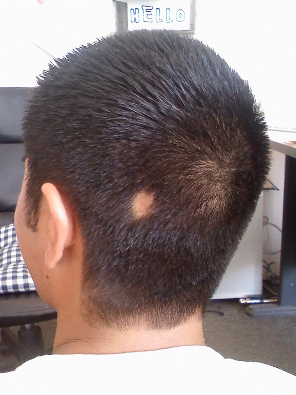 Alopecia areata: Kopfhaut