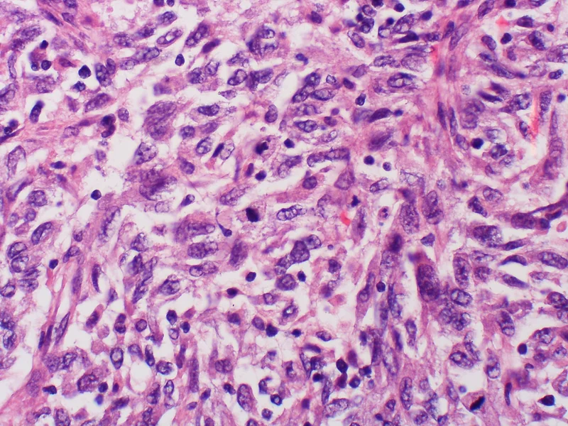 Amelanotic melanoma – histology (H&E), detail (specimen from a melanoma metastasis): densely packed spindled and epithelioid tumour cells with marked nuclear pleomorphism and prominent nucleoli, entirely free …