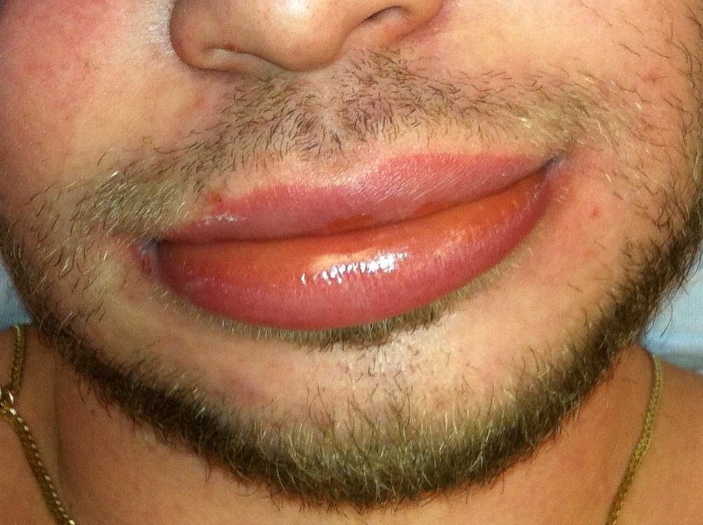 Angioödem: pralle, blasse bis leicht gerötete Schwellung beider Lippen ohne Quaddeln
