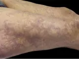 Antiphospholipid-Syndrom – Hautmanifestationen (Livedo racemosa, Sneddon-Syndrom)