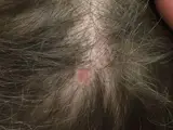 Aplasia cutis congenita