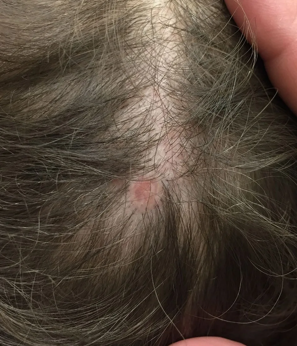 Aplasia cutis congenita – klinisches Foto: kleiner, rundlicher, haarloser, rosafarbener atropher Herd am Scheitel der Kopfhaut