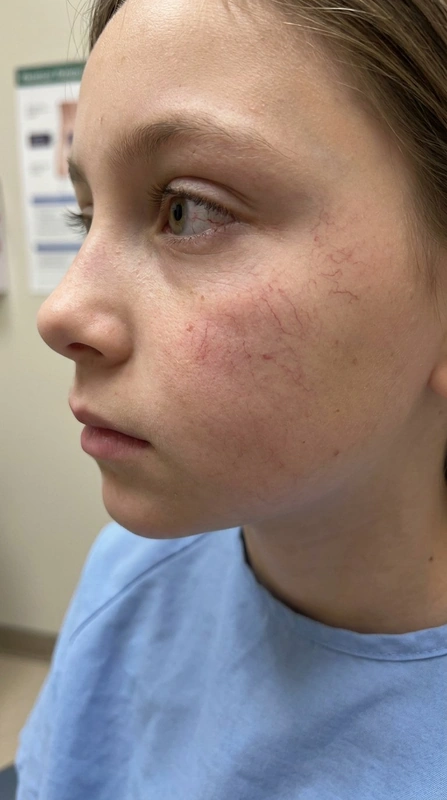 Ataxia teleangiectatica (Louis-Bar-Syndrom) – Kind – KI-Illustration (kein Patientenfoto): telangiectasias on bulbar conjunctiva and over malar areas in a young child with neurologic posture, 8-year-old girl