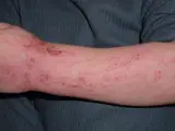 Atopic dermatitis (atopic eczema) – clinical photo