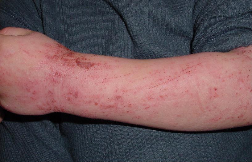 Atopic dermatitis (atopic eczema): erythematous, papular eczematous patches on the forearm of a 5-year-old child