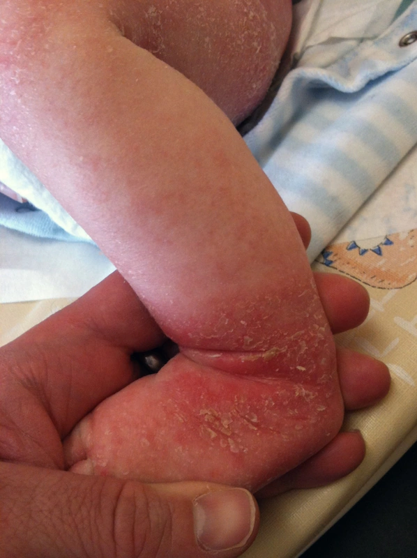 Atopic dermatitis (atopic eczema): inflamed, scaly eczema on the ankle of a 2-month-old infant