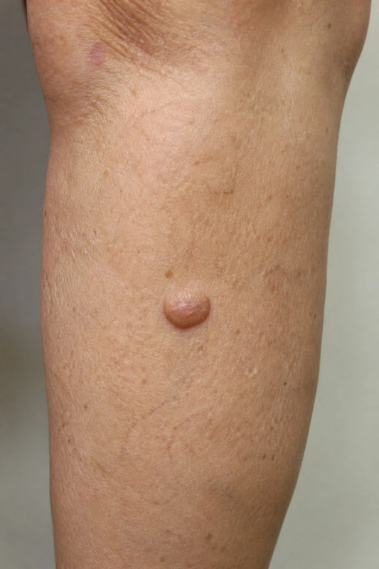 Atypisches Fibroxanthom (AFX): rasch wachsender rötlicher Knoten lichtexponiert bei älteren Patienten (Mann, Unterschenkel)