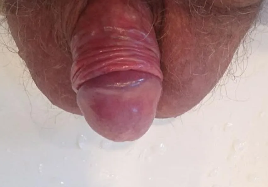 Balanitis plasmacellularis Zoon – Intimbereich – klinisches Foto: glänzend rote, feuchte Areale an Glans und innerem Präputialblatt