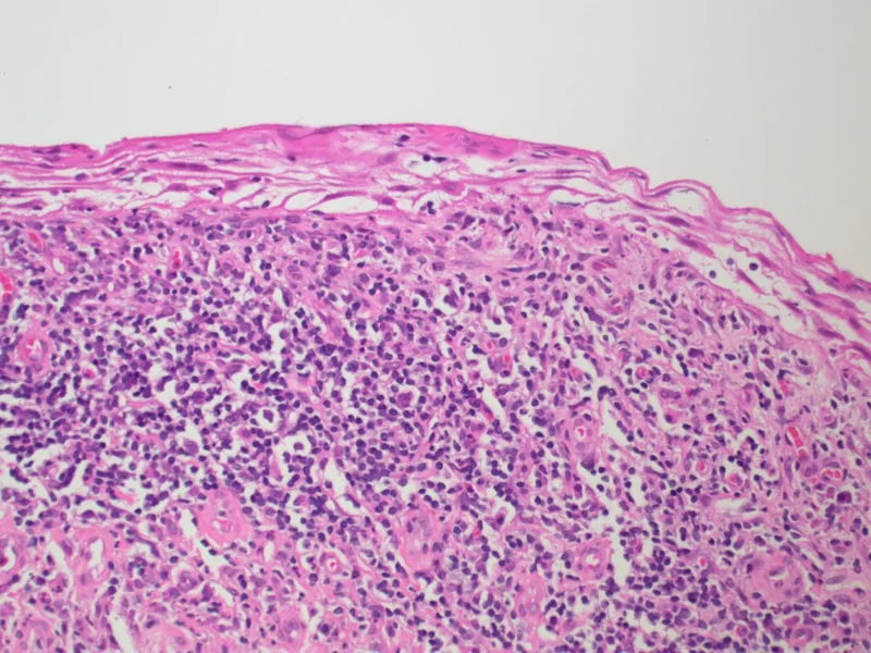 Balanitis plasmacellularis Zoon – Histologie (HE): atrophe, verschmälerte Epidermis über einem bandförmigen, plasmazellreichen Infiltrat mit dilatierten Gefäßen