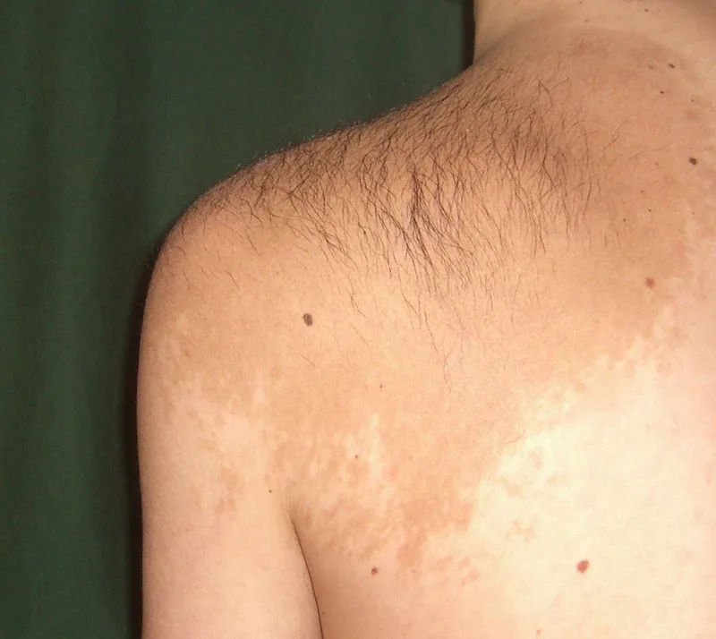 Becker-Nävus (Becker-Melanose) – klinisches Foto: großflächige, unregelmäßig begrenzte hellbraune Hyperpigmentierung mit Hypertrichose an Schulter und oberem Rücken