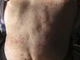 Bullöses Pemphigoid