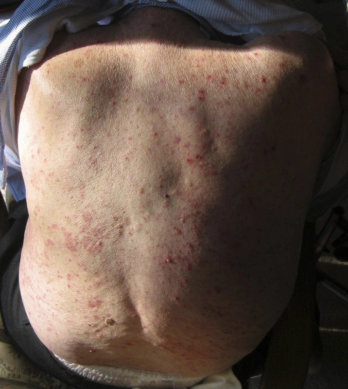 Bullous pemphigoid: urticarial plaques and scattered blisters on the back of an 88-year-old man