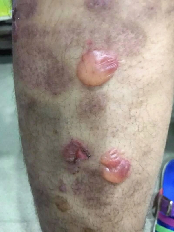 Bullous pemphigoid: tense, partly haemorrhagic blisters on an erythematous base on the lower leg