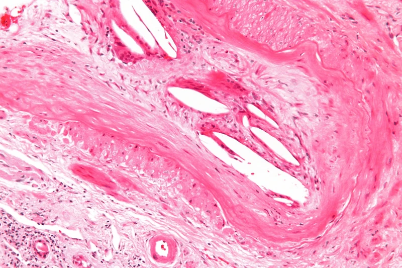 Cholesterol embolism (atheroembolism) – histology (H&E; not a skin section, artery in soft tissue): needle-shaped cholesterol clefts within the lumen of a medium-sized artery, fibrous organisation with luminal obliteration and …