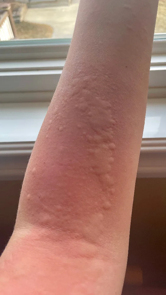 Kälteurtikaria (Kälteallergie) – Unterarm – klinisches Foto: zahlreiche kleine, teils konfluierende Quaddeln auf geröteter Haut nach Kälteexposition
