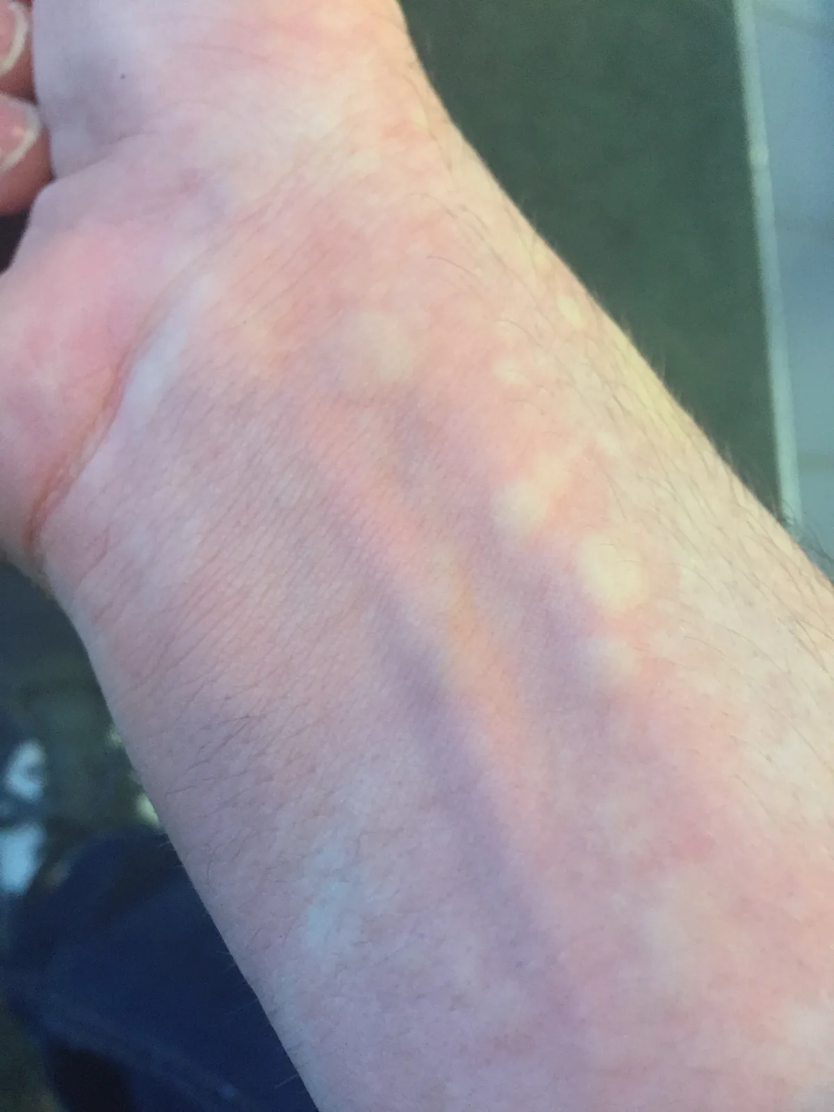 Kälteurtikaria (Kälteallergie) – Handgelenk, Unterarm – klinisches Foto: blasse, erhabene Quaddeln mit diskretem Randerythem