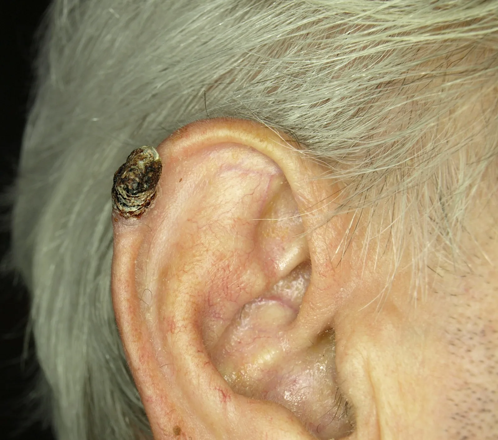 Cornu cutaneum (Hauthorn) – klinisches Foto: kegelförmiges, gelbbraun-schwärzliches Keratinhorn mit geschichteter Seitenfläche am oberen Helixrand der Ohrmuschel