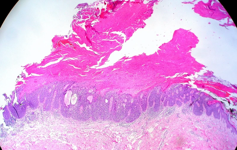Cornu cutaneum (Hauthorn) – Histologie (HE, Übersicht): massive kompakte Hyper- und Parakeratose als hohe Hornsäule über einer akanthotischen, basaloiden Epithelproliferation mit bandförmigem lymphozytärem …