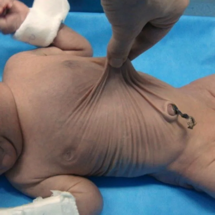 Cutis laxa (generalisierte Elastolyse) – Oberkörper – klinisches Foto: schlaffe, überschüssige Bauch- und Rumpfhaut, die sich weit abheben lässt und feine Falten wirft