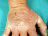 Dermatitis herpetiformis Duhring