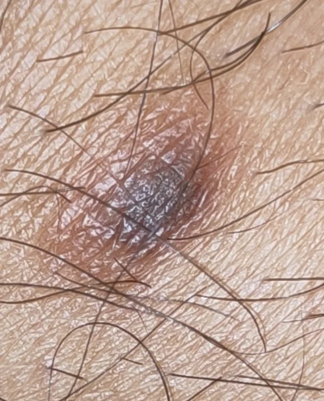Dermatofibrom: pigmentierter, derber Knoten am Bein eines 34-jährigen Mannes (Dimple-Zeichen typisch bei Kompression).