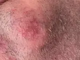 Dermatofibrosarcoma protuberans (DFSP)