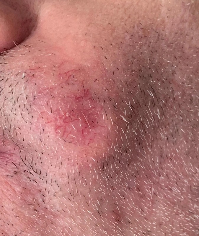 Dermatofibrosarcoma protuberans: firm, reddish-violaceous nodular tumor on the upper lip.