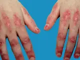 Dermatomyositis