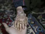 Epidermolysis bullosa hereditaria