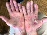 Epidermolysis bullosa acquisita