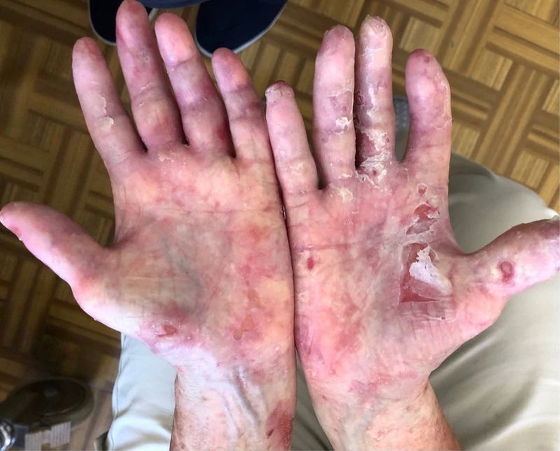 Epidermolysis bullosa acquisita: Erosions, blisters and scarring of both palms in epidermolysis bullosa acquisita (photo: Szymański, Kowalewski, Pietrzyk et al. (2023), Europe PMC, CC BY 4.0) (Foto: Szymański, Kowalewski, Pietrzyk et al. (2023), Wikimedia Commons, CC BY 4.0)
