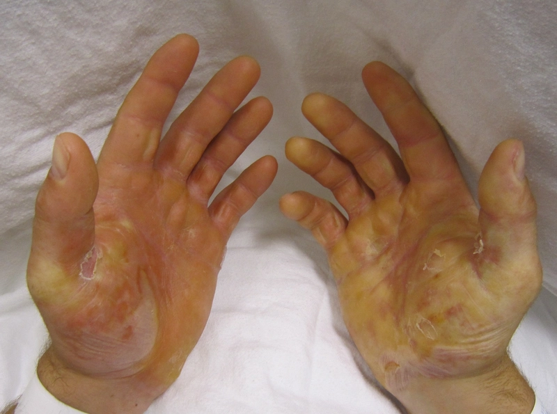 Epidermolysis bullosa simplex: ausgedehnte Blasen und Erosionen an beiden Händen.