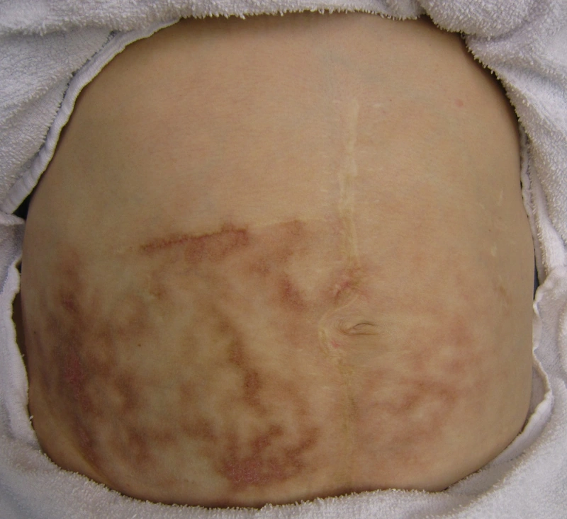 Erythema ab igne: retikuläre, netzartige Hyperpigmentierung nach chronischer Wärmeexposition (Wärmflasche) am Abdomen